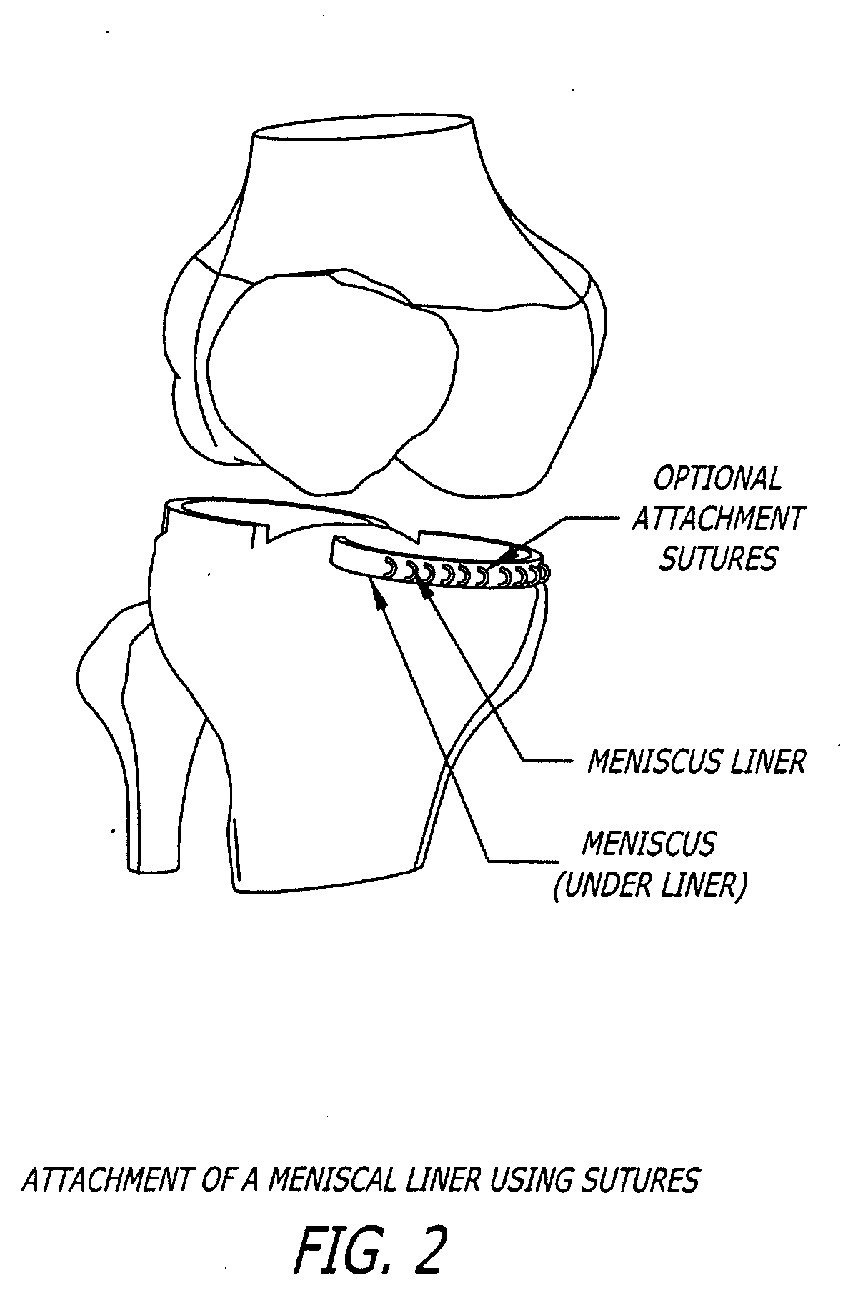 Knee joint prosthesis and hyaluronate compositions for treatment of osteoarthritis