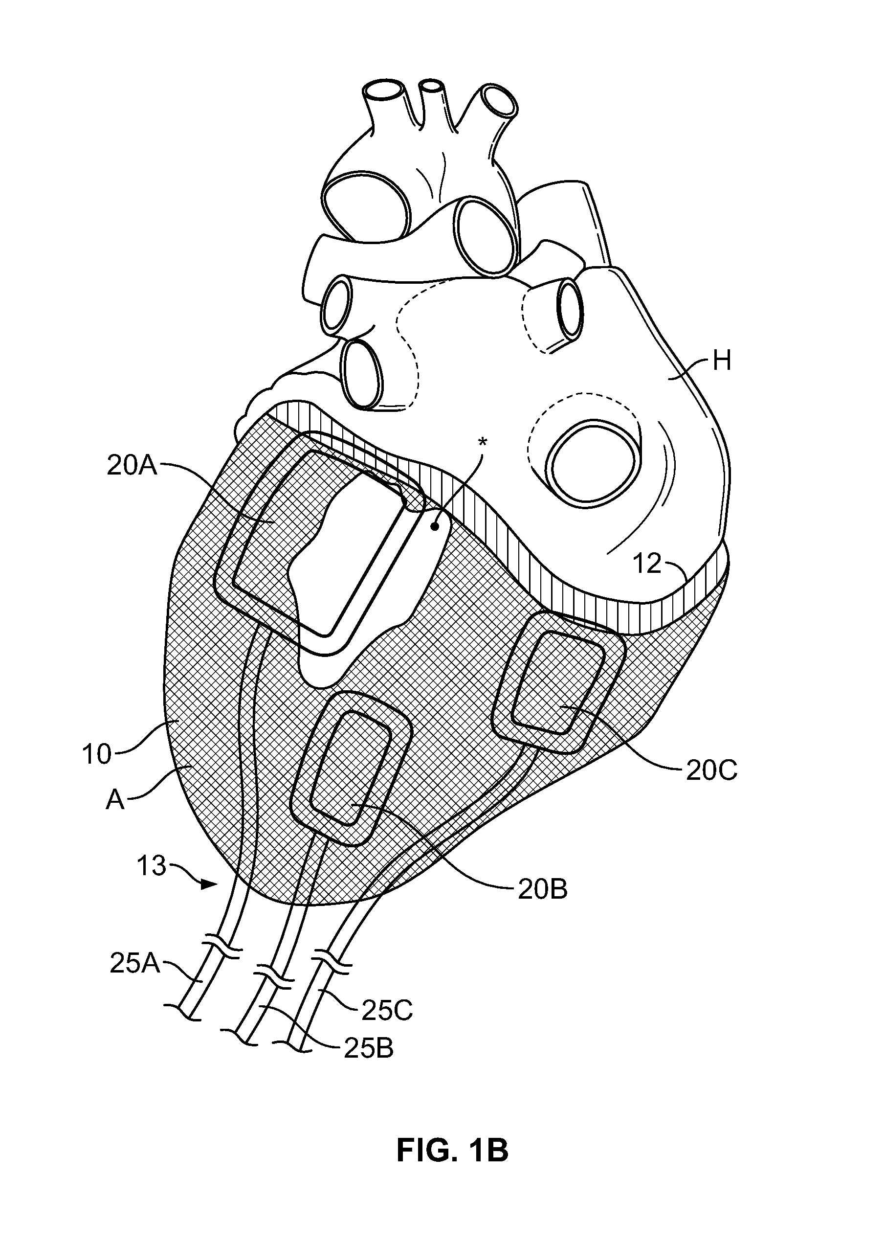 Cardiac treatment system