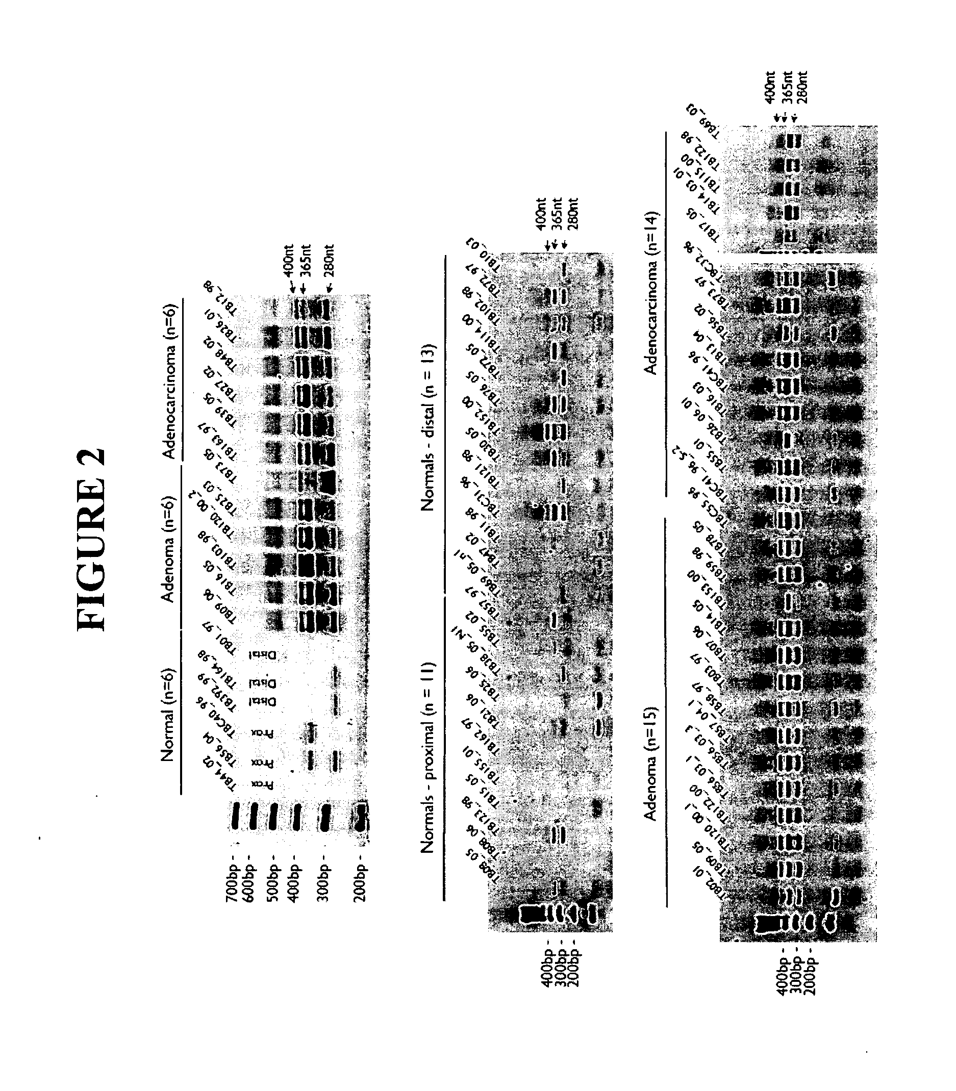 Method of diagnosing neoplasms