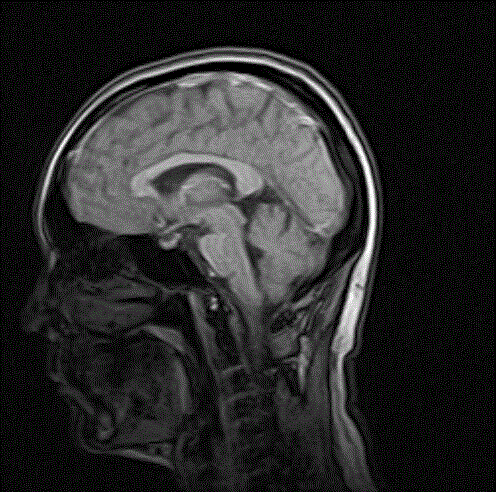 A method and system for automatically extracting corpus callosum from magnetic resonance images