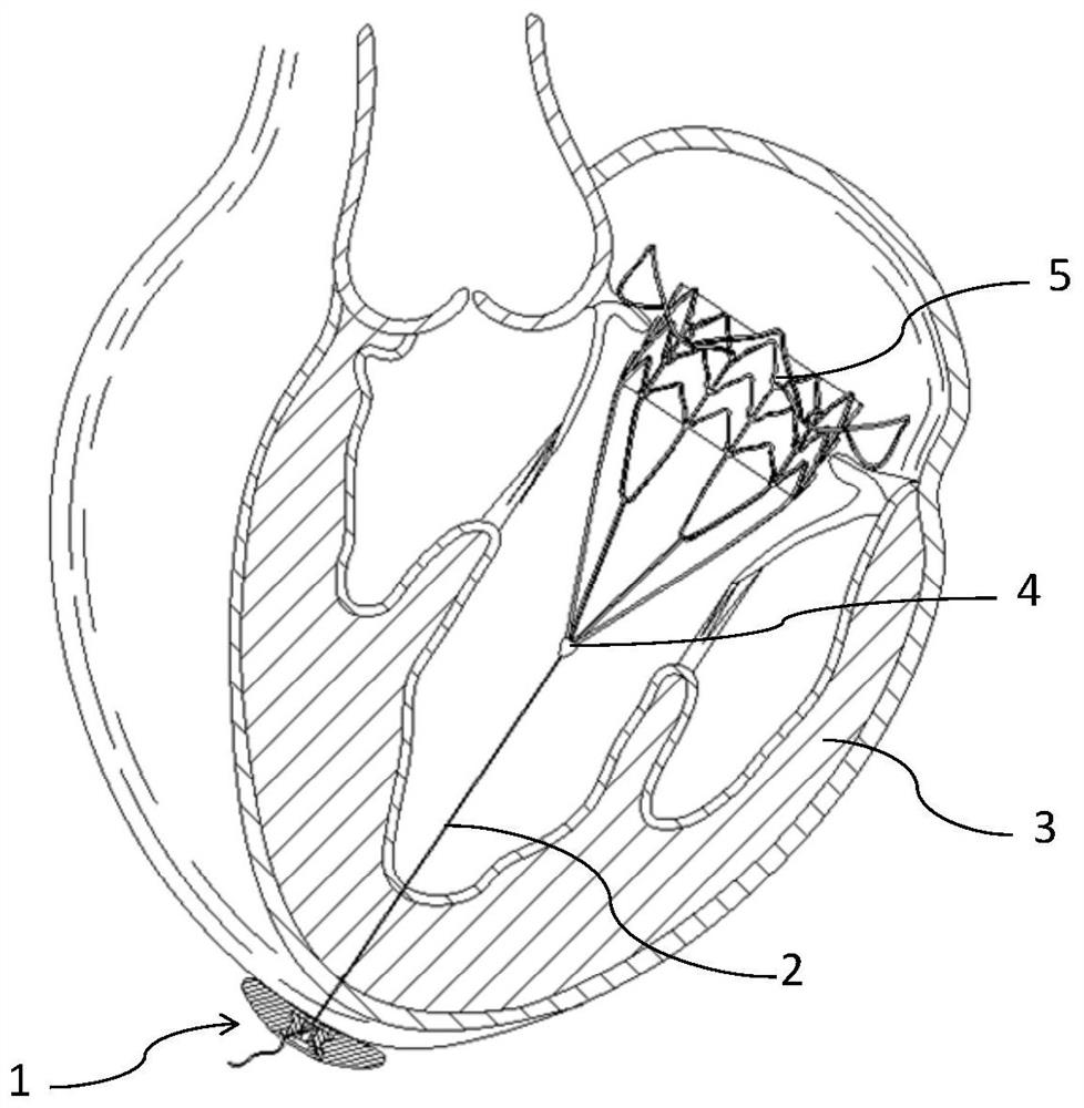 Fixtures for Interventional Medical Devices