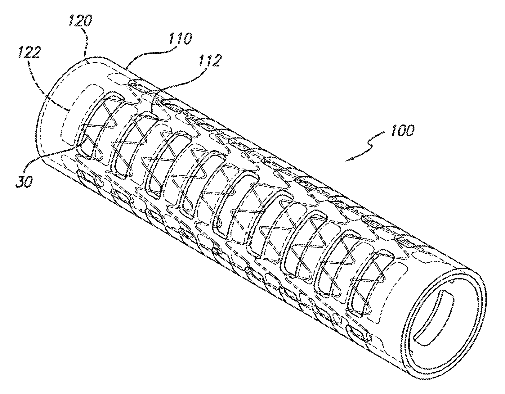 Partial encapsulation of stents