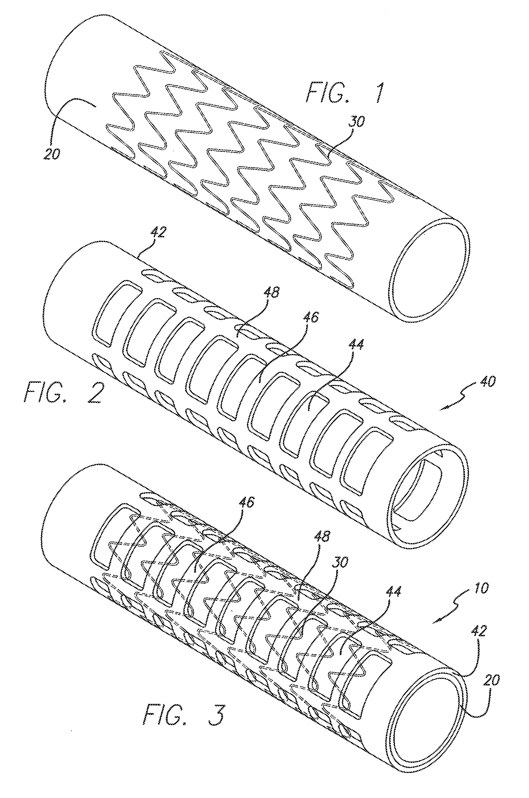 Partial encapsulation of stents