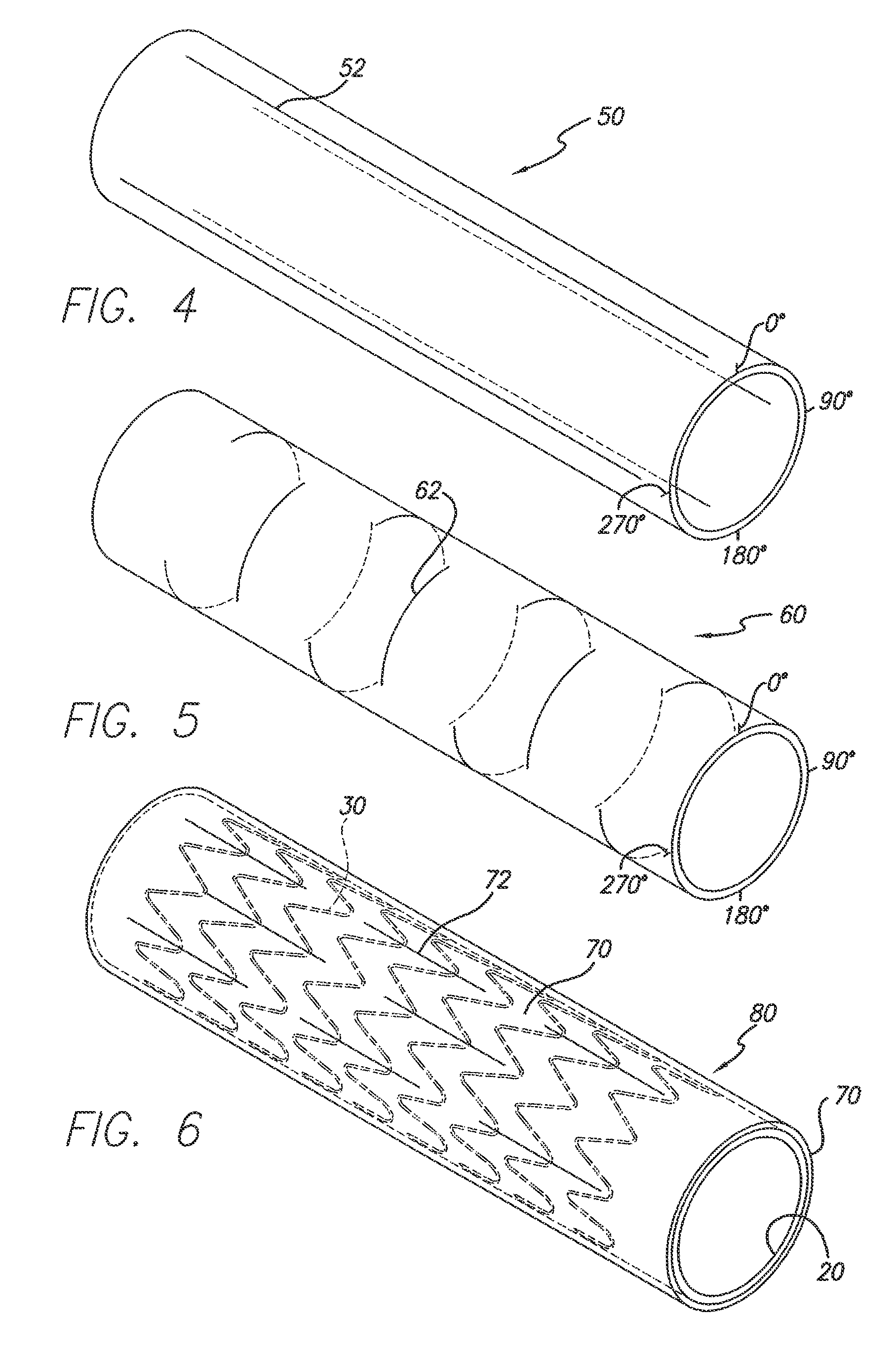 Partial encapsulation of stents