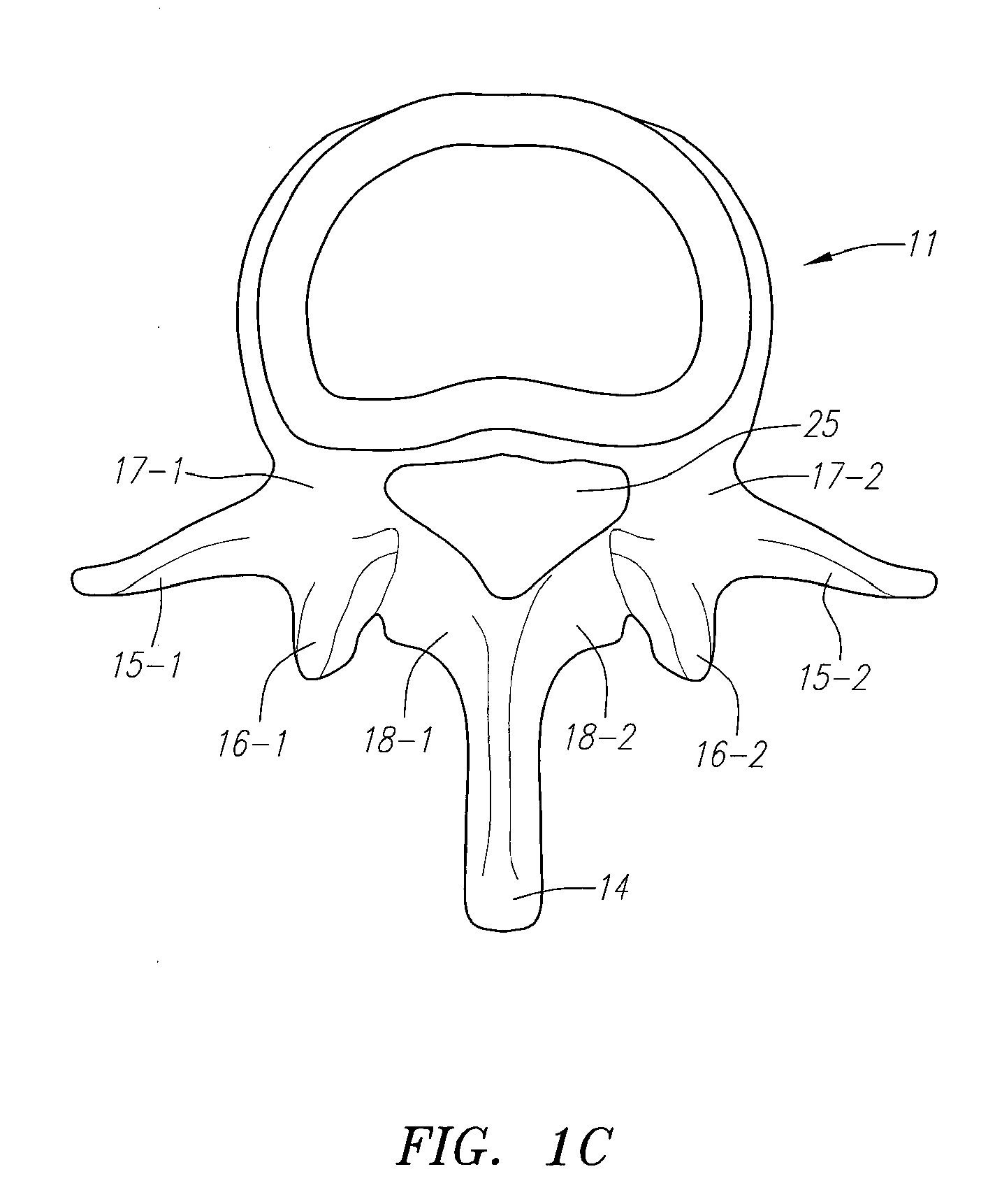 Spacer Devices and Systems for the Treatment of Spinal Stenosis and Methods for Using the Same