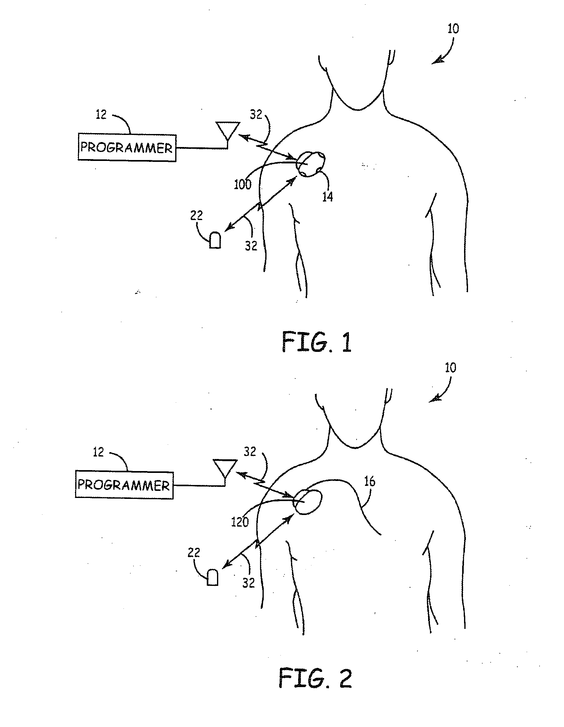 System and method for segmenting a cardiac signal based on brain stimulation