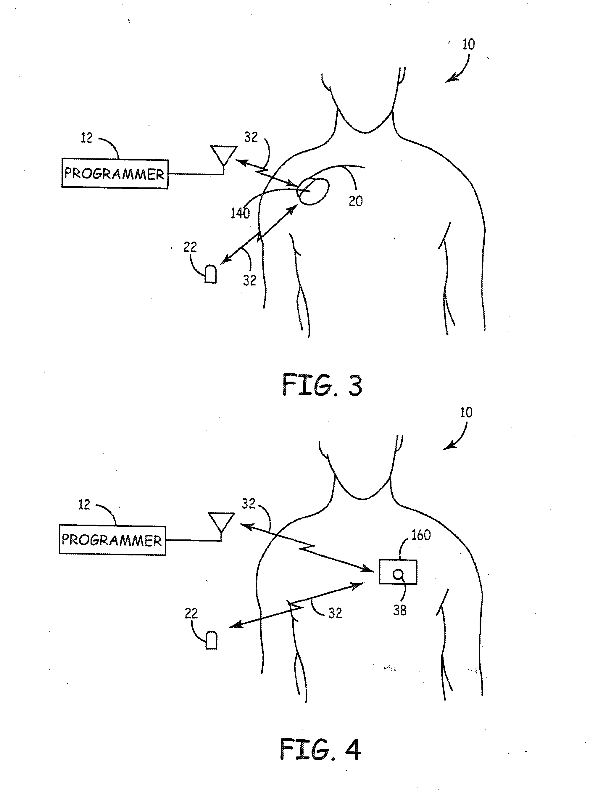 System and method for segmenting a cardiac signal based on brain stimulation