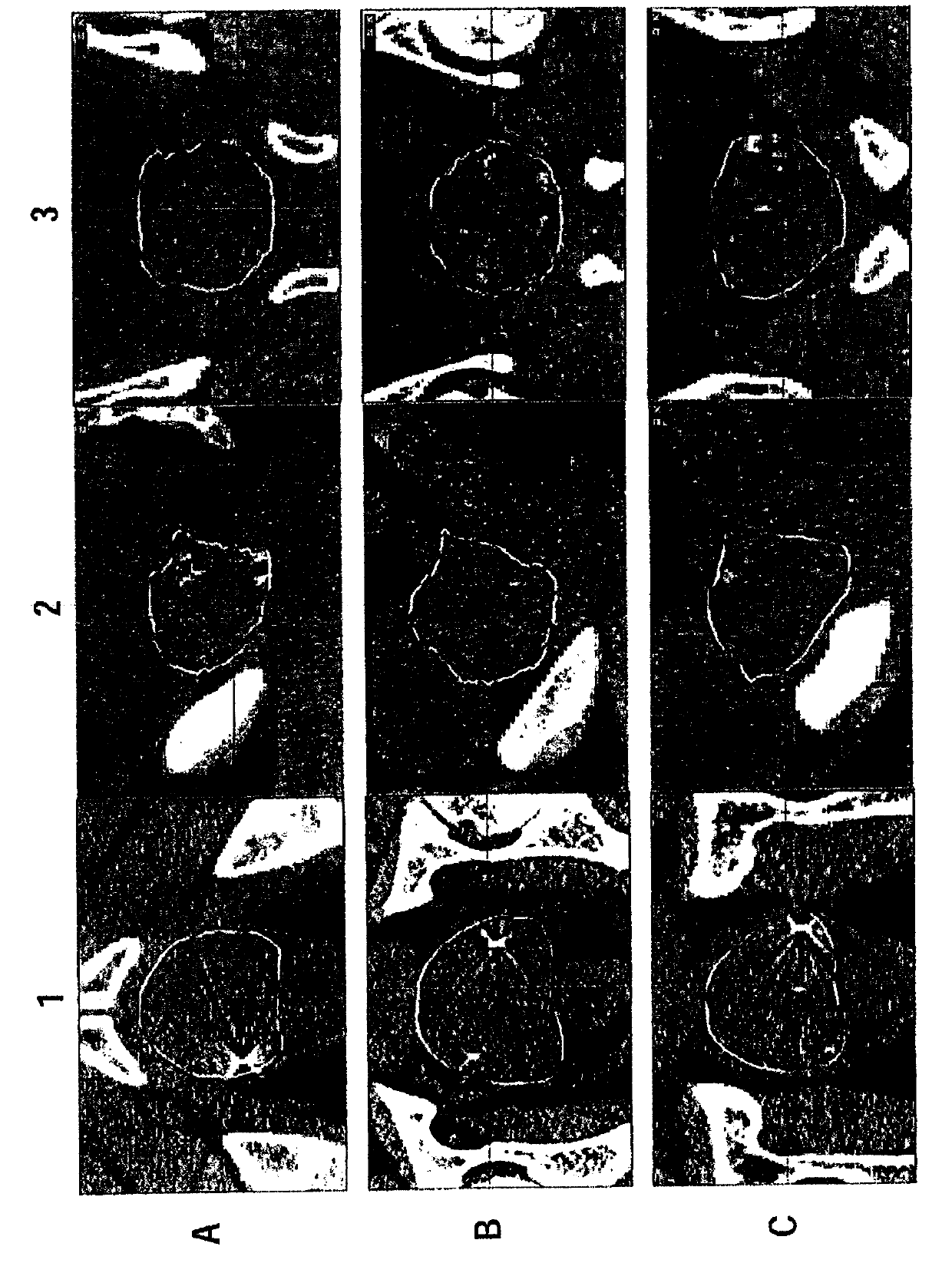 Systems and methods for automatic contouring in adaptive radiation therapy