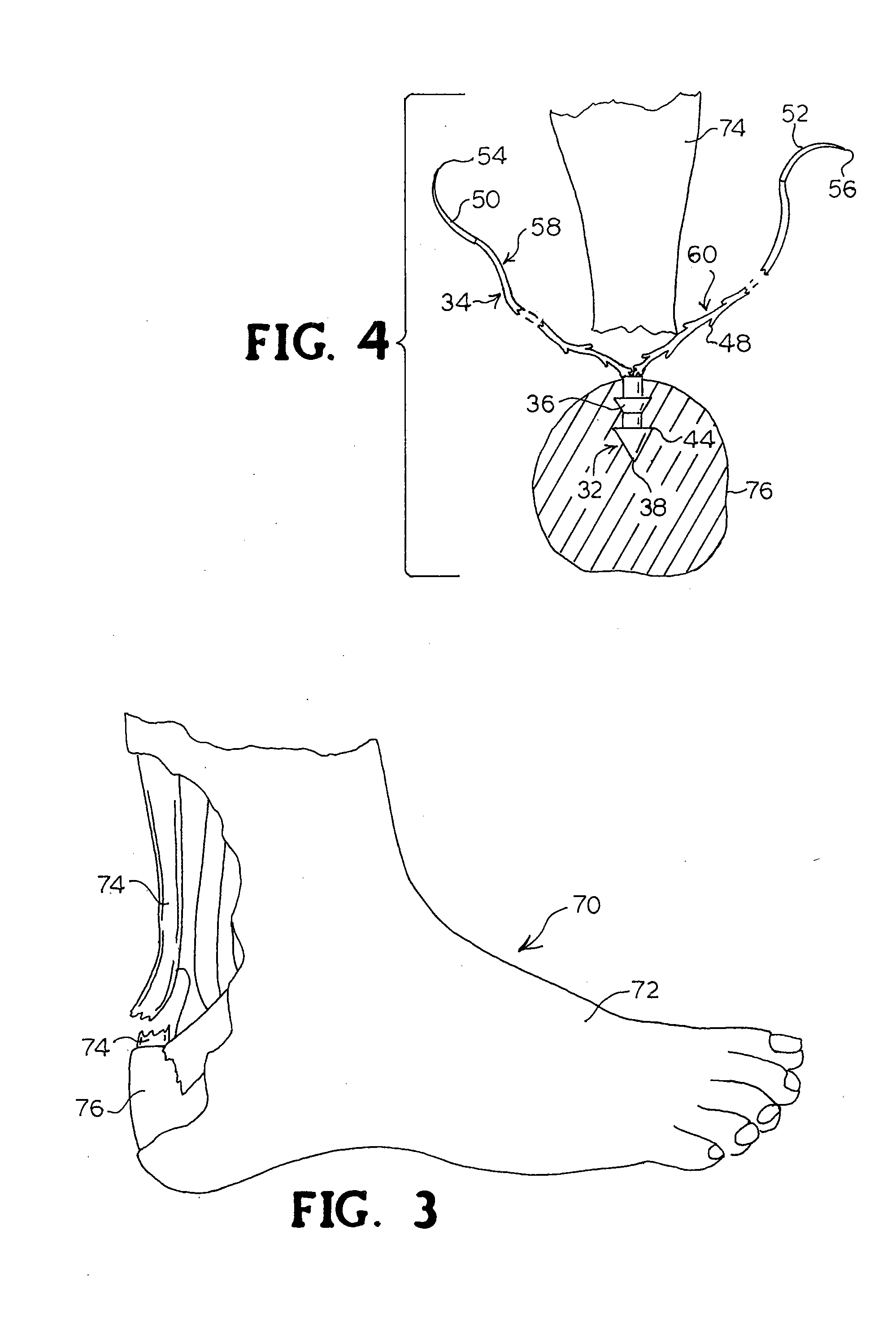 Multiple suture thread configuration with an intermediate connector