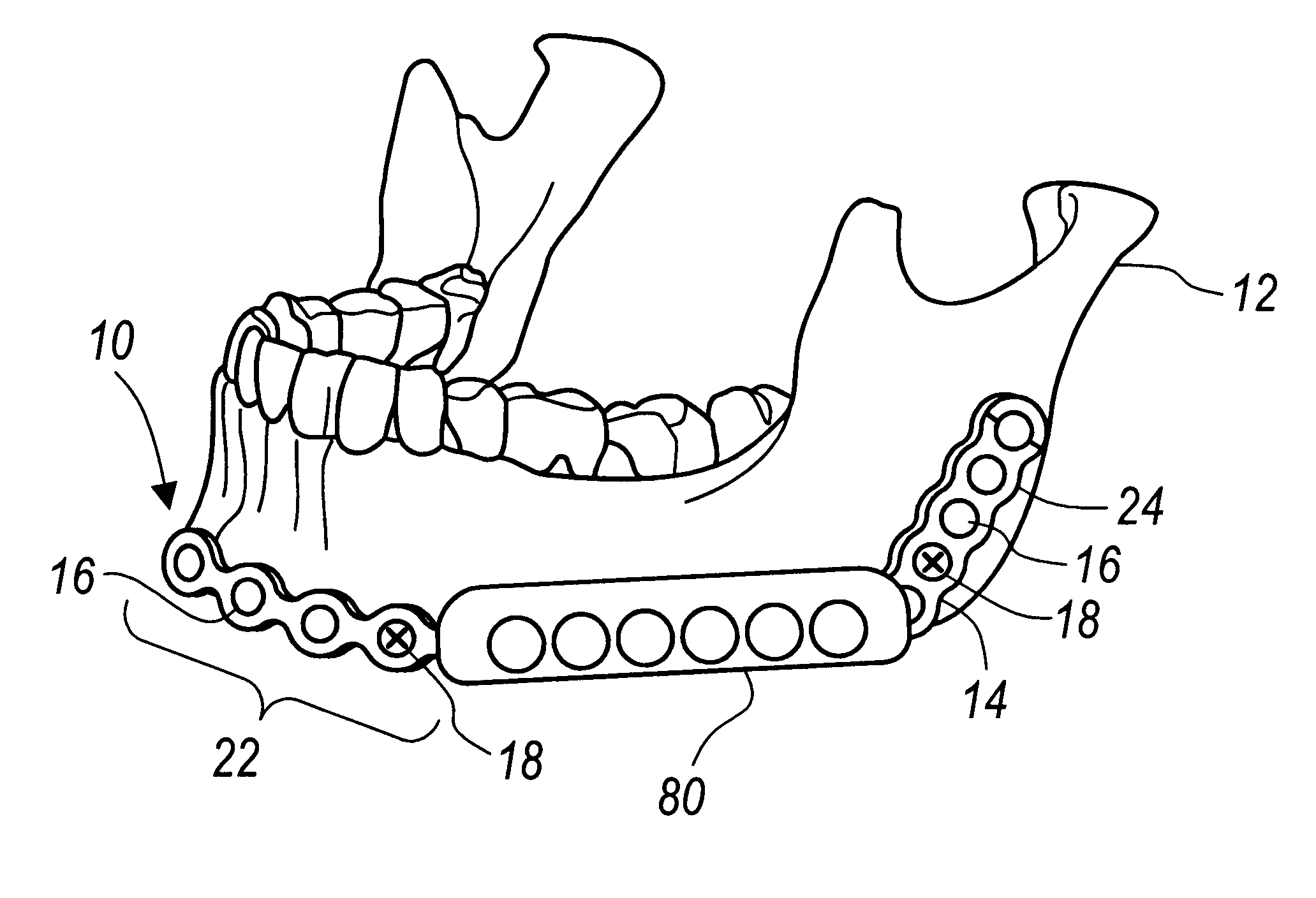 Cover for plate for mandibular osteosynthesis