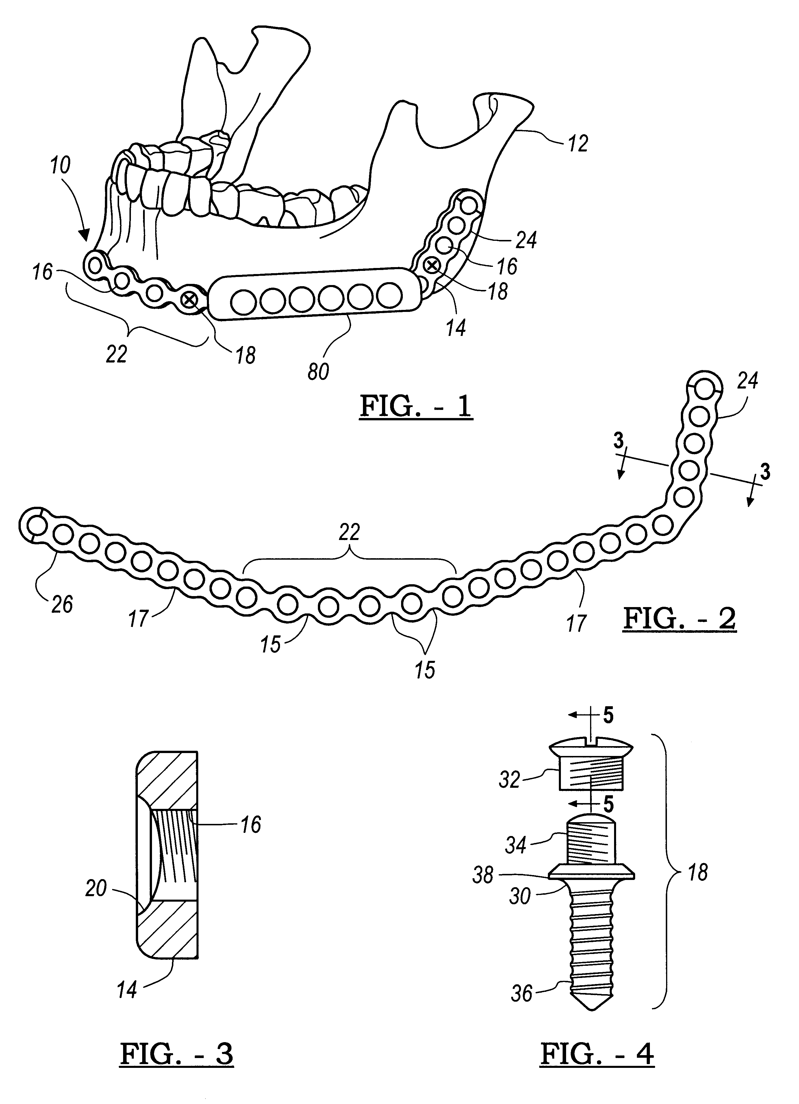 Cover for plate for mandibular osteosynthesis