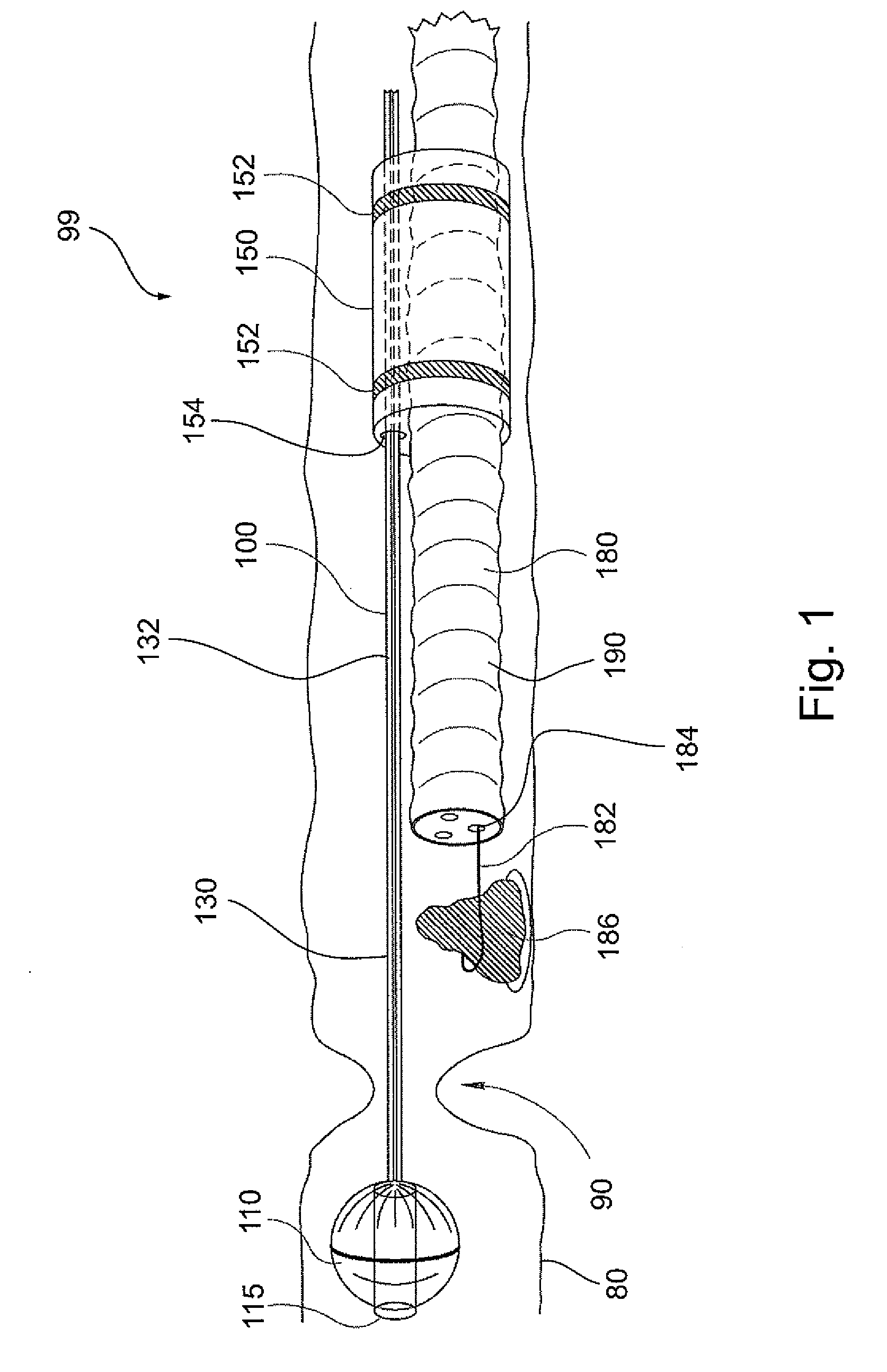 System and method for navigating a tool within a body conduit