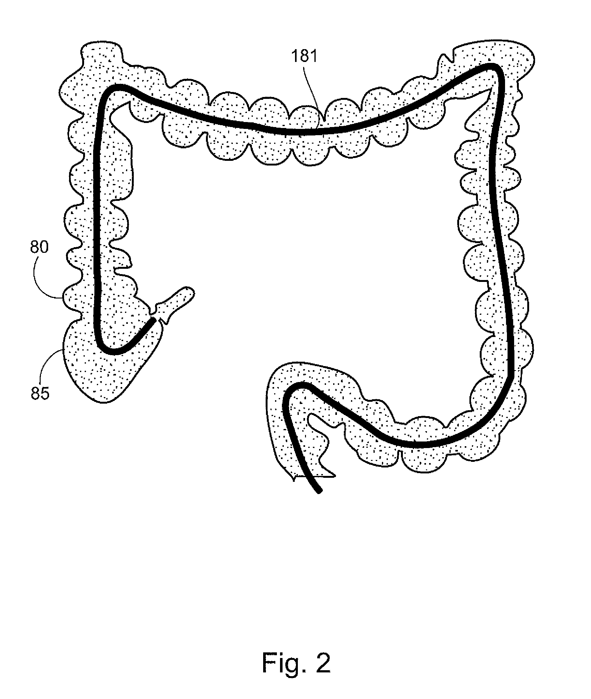 System and method for navigating a tool within a body conduit