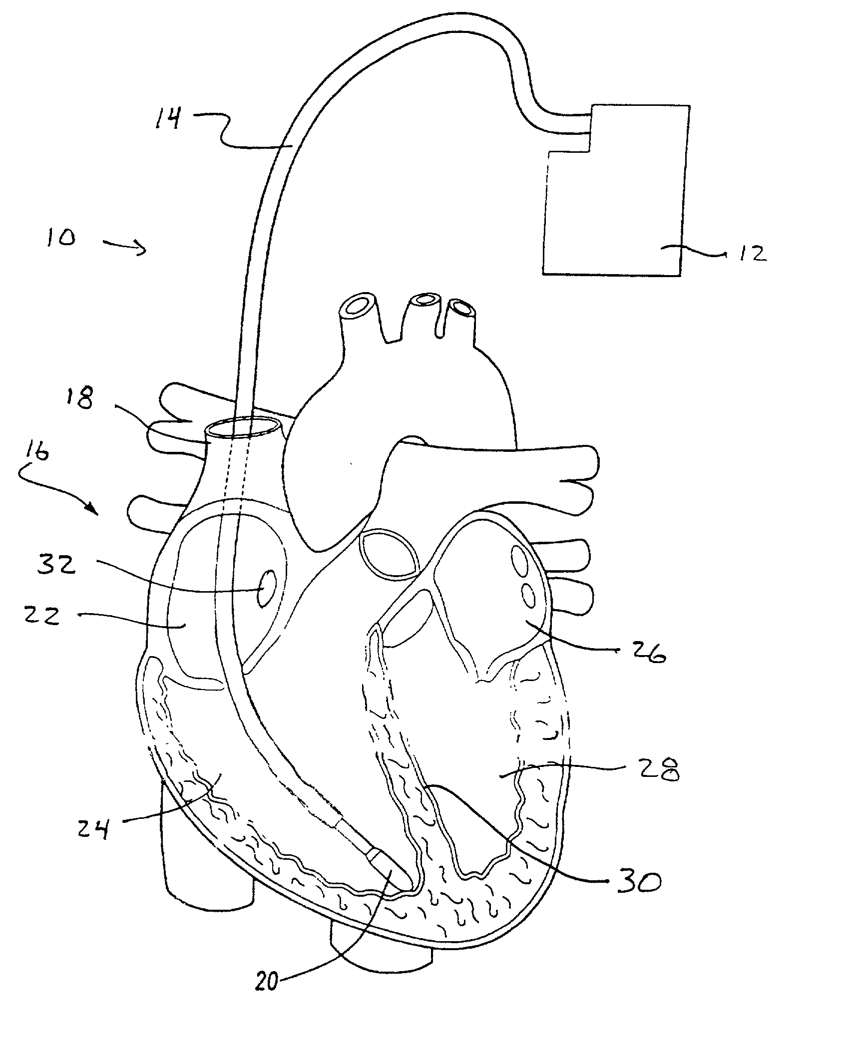 Method and apparatus for endovenous pacing lead