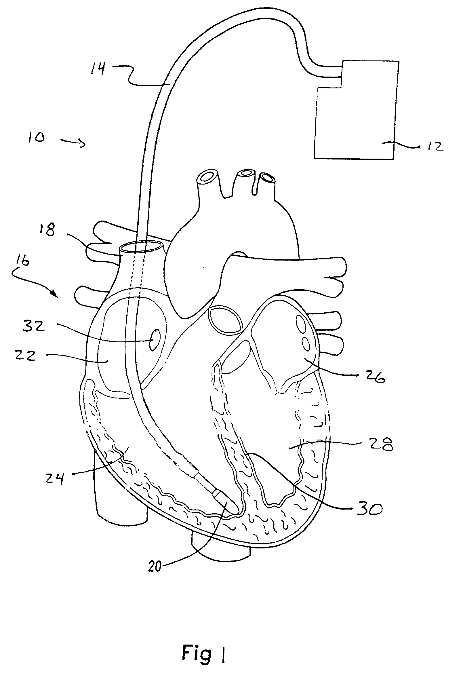 Method and apparatus for endovenous pacing lead