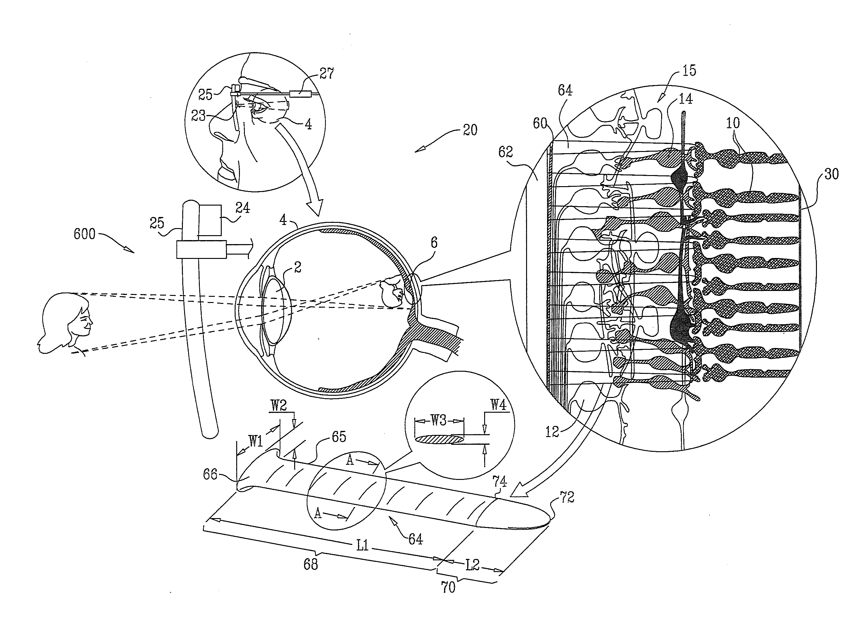 Retinal prosthesis techniques