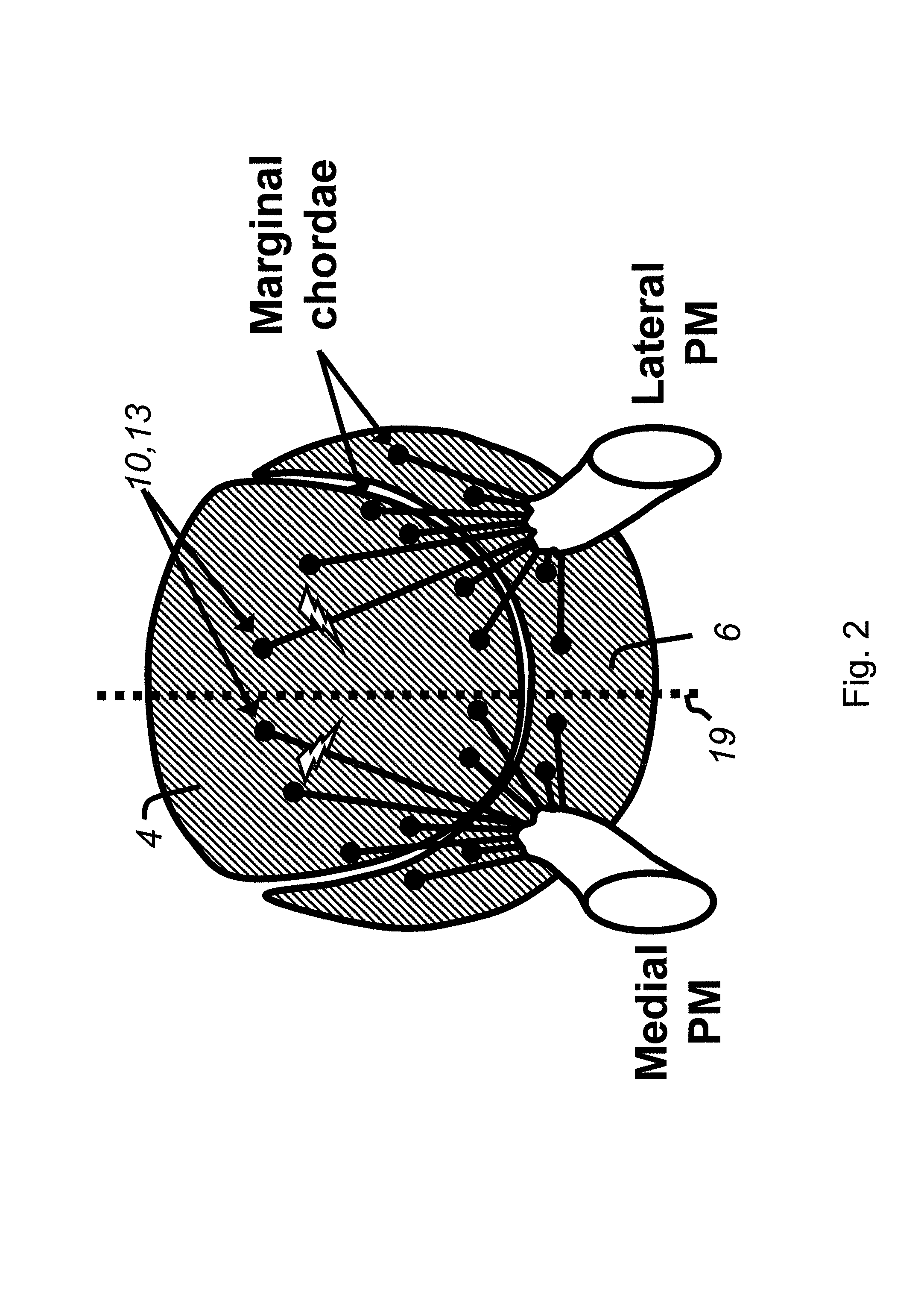 Cardiac devices and methods for minimally invasive repair of ischemic mitral regurgitation