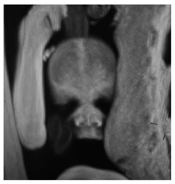 Three-dimensional imaging method for visualization of fetal body surface structure based on magnetic resonance scanning