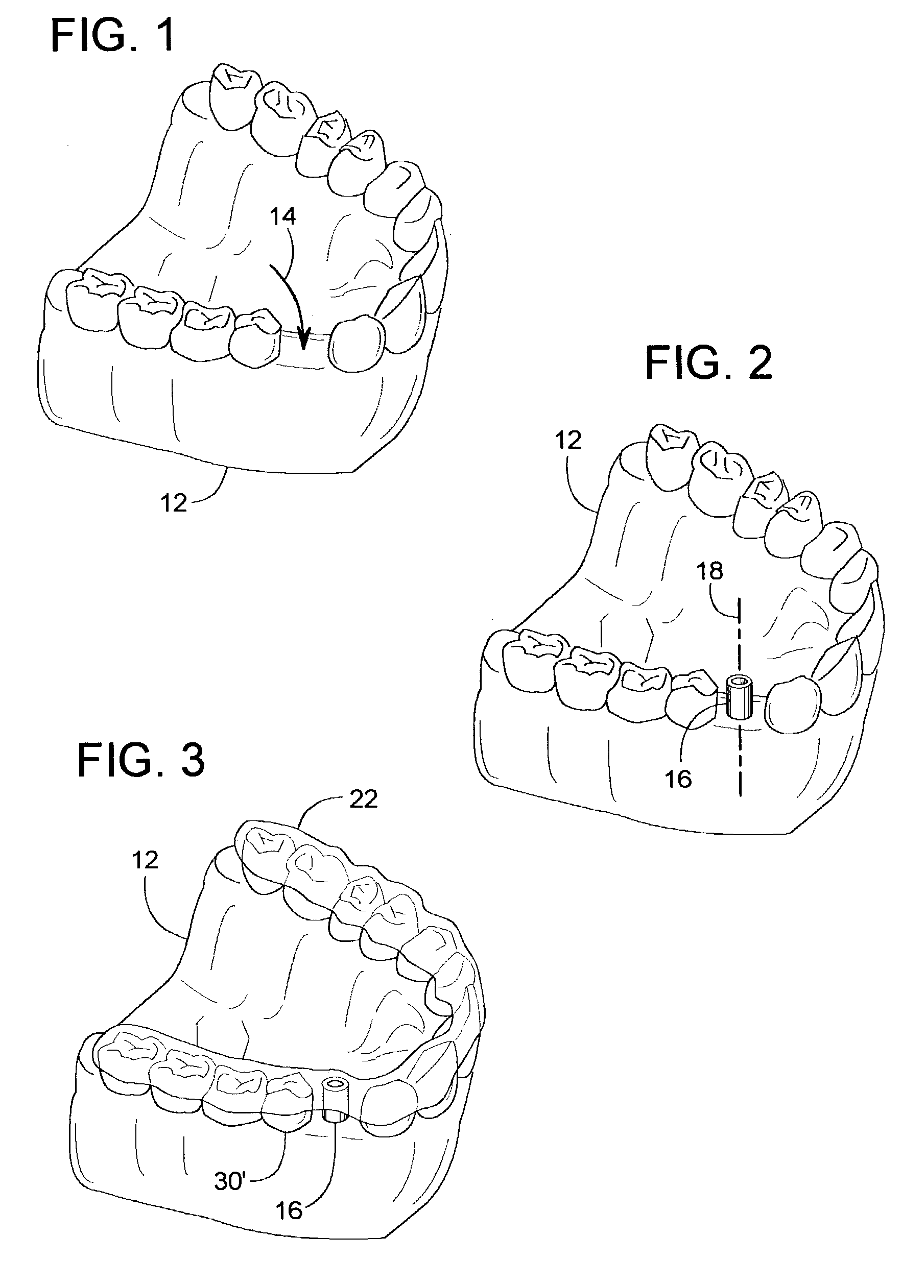 Method of installing a dental implant