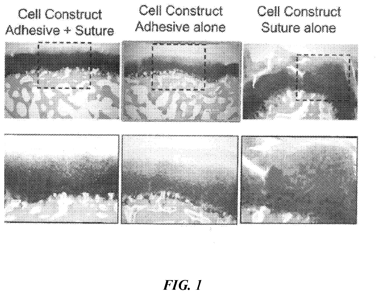 Scaffold with adhesive for articular cartilage repair