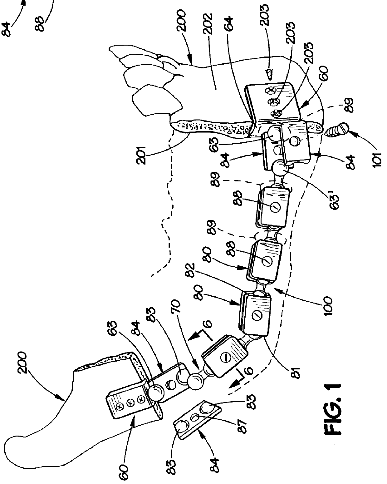 Modular mandibular prosthesis