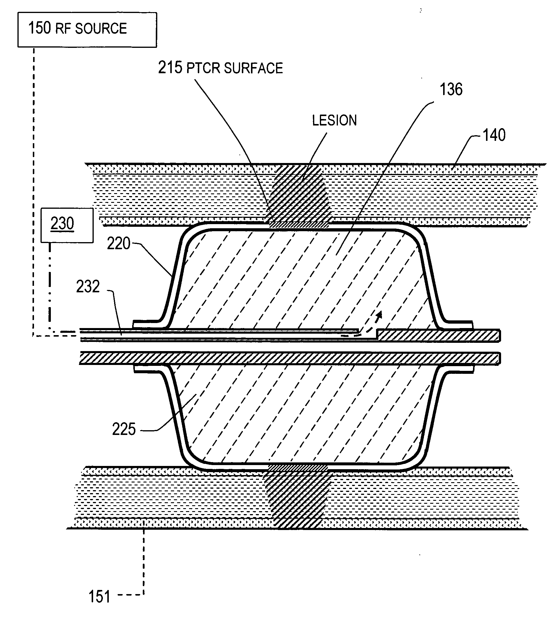 Endovascular catheter and method of use