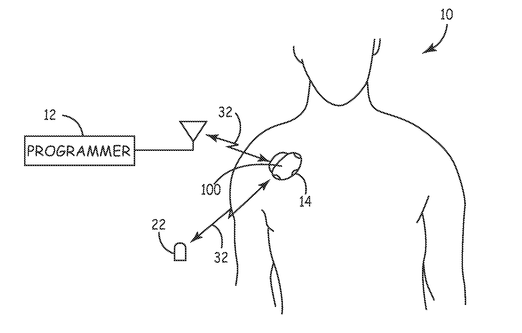 System and method for regulating cardiac triggered therapy to the brain