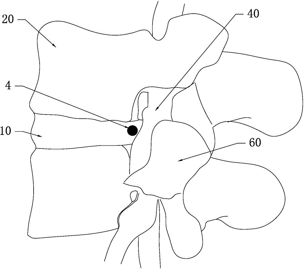 Gear Adjustable Lumbar Disc Herniation Target Aimer