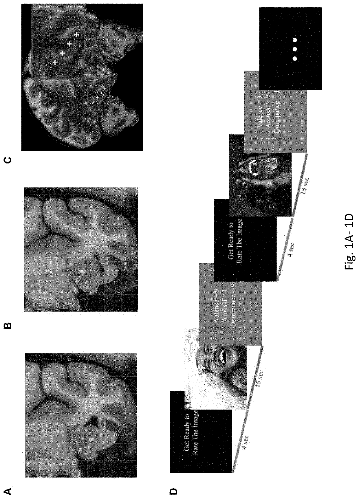 Compositions and Methods for Treatment of Post-Traumatic Stress Disorder using Closed-Loop Neuromodulation