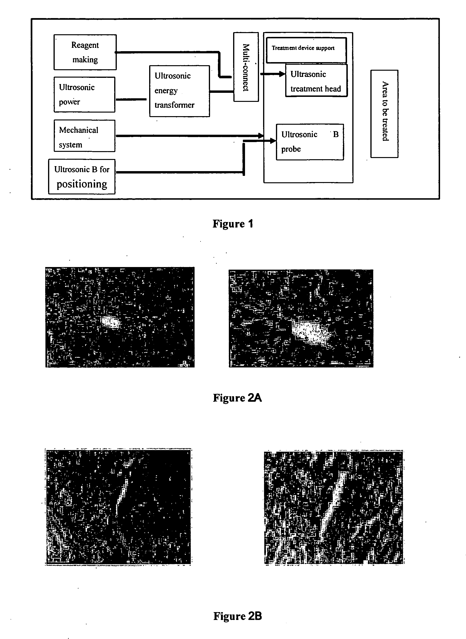 Method, reagent, and device for embolizing blood vessels in tumors with ultrasonic radiation micro-bubble reagent