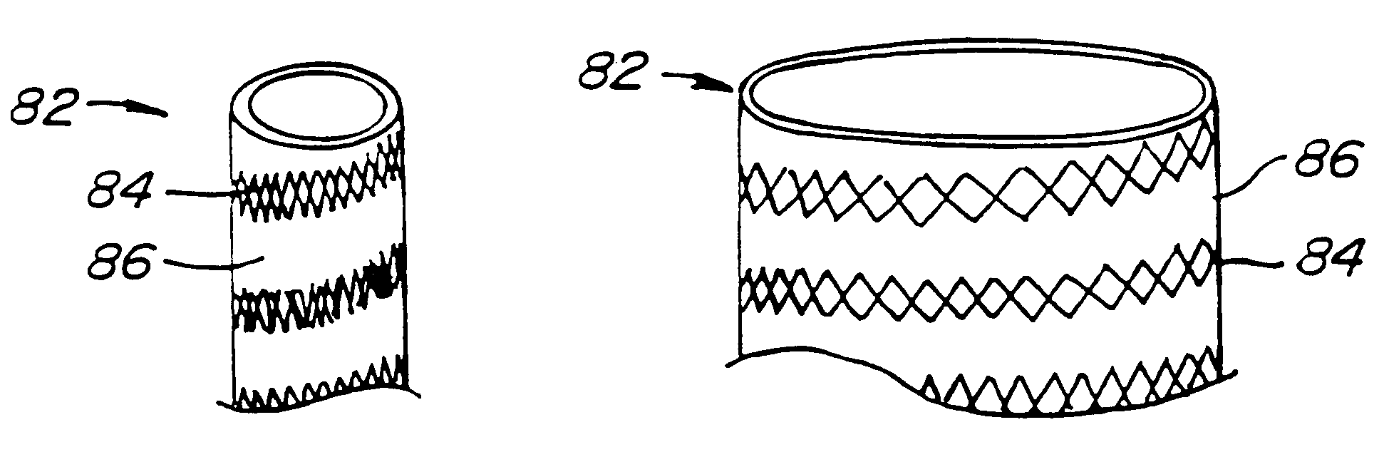 Endoluminal prostheses and therapies for highly variable body lumens