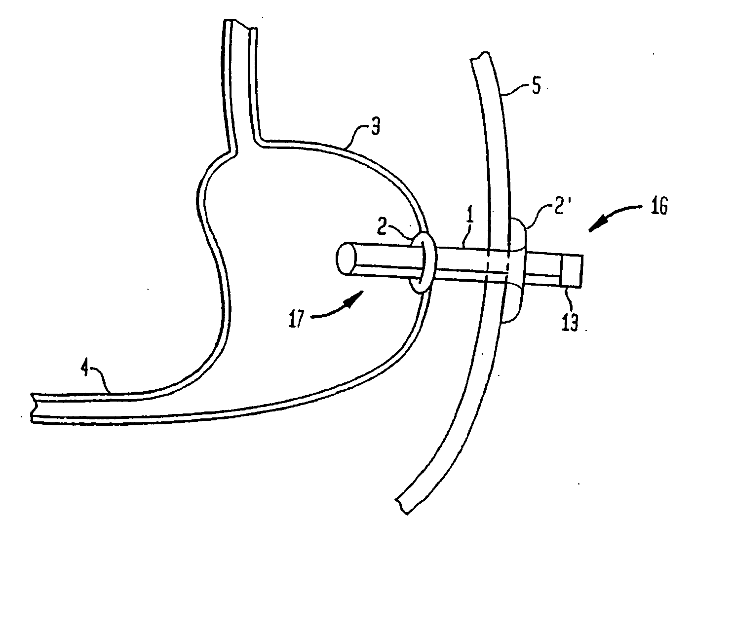 Shunt apparatus for treating obesity by extracting food