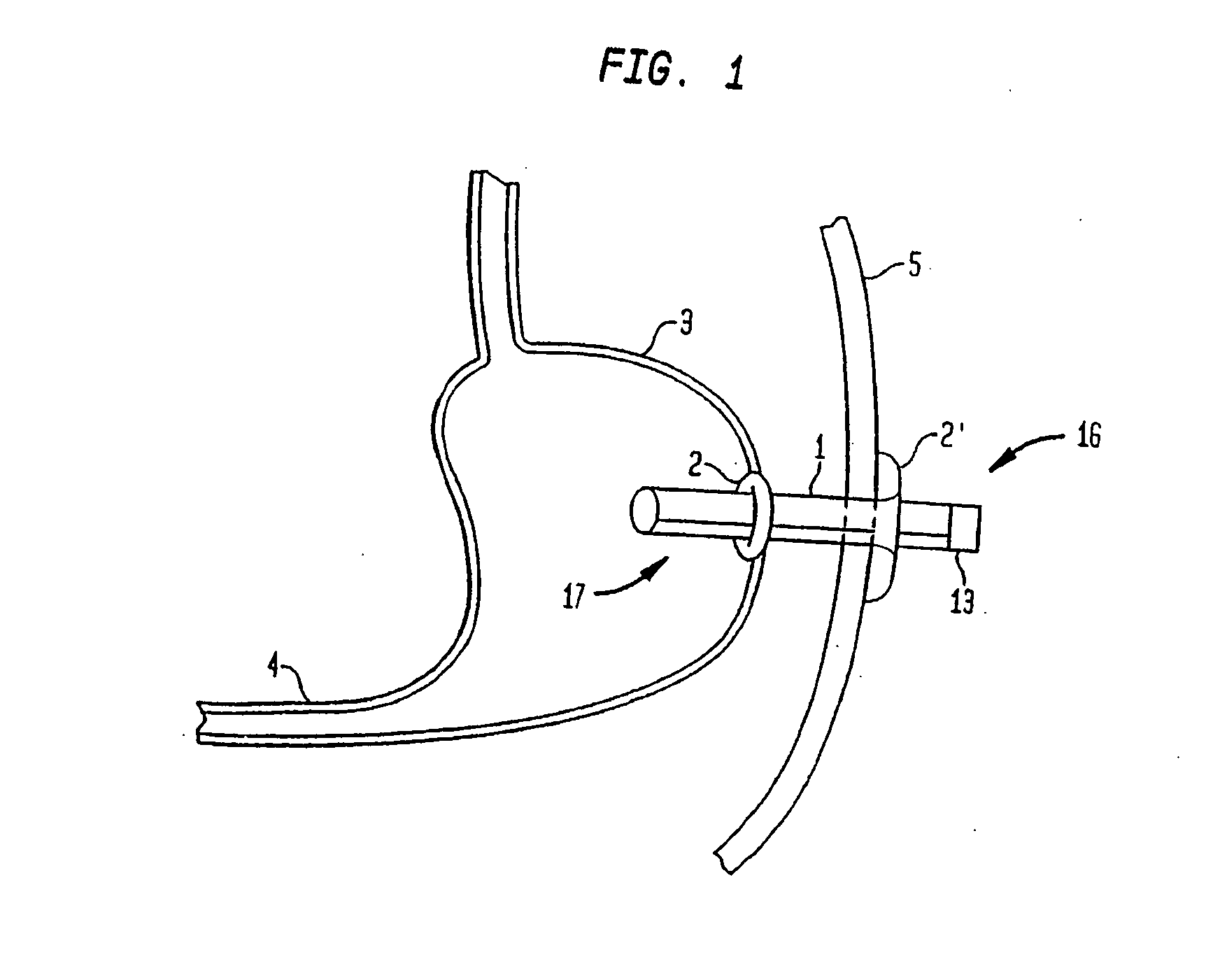 Shunt apparatus for treating obesity by extracting food