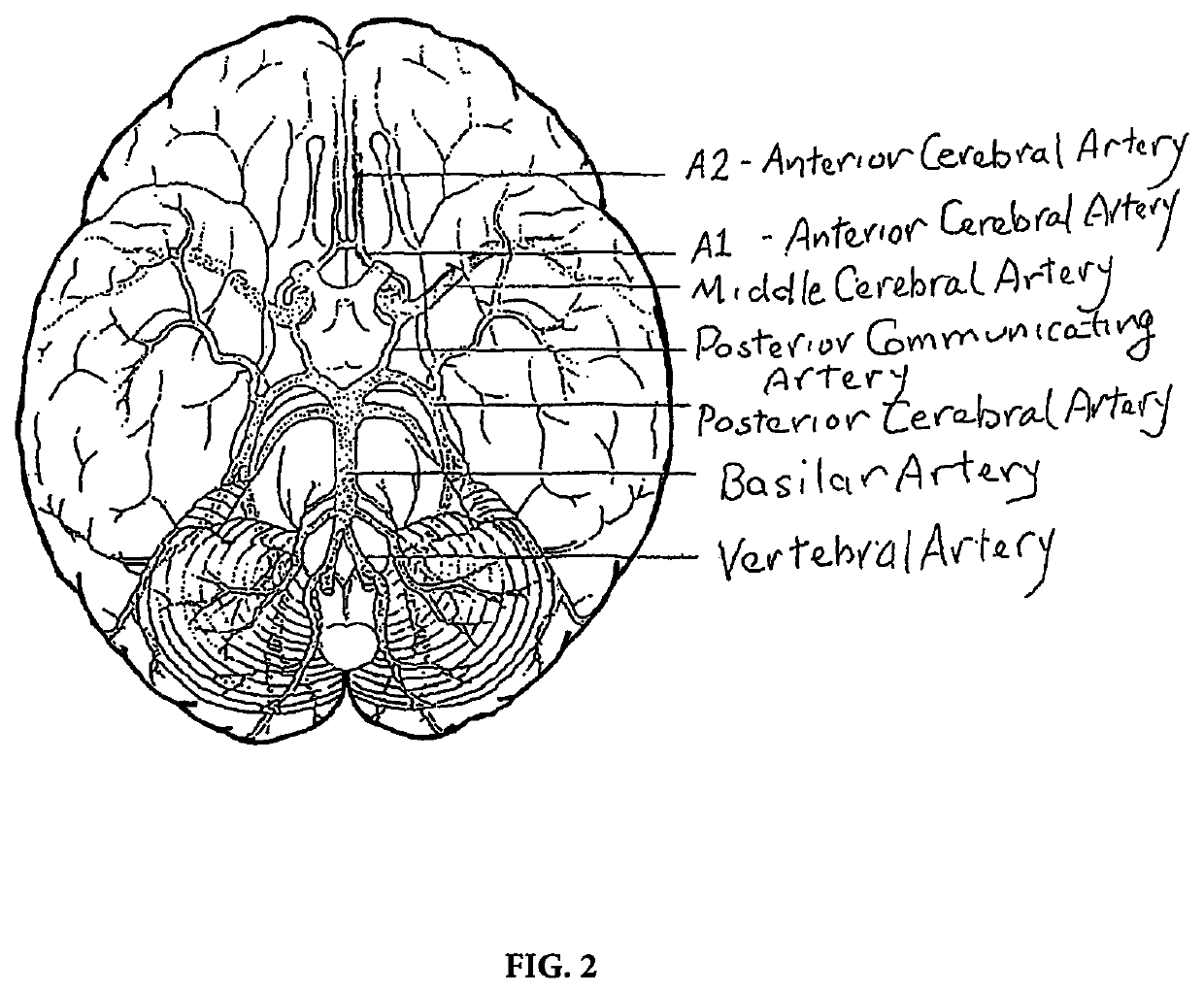 Methods and devices to ameliorate vascular obstruction