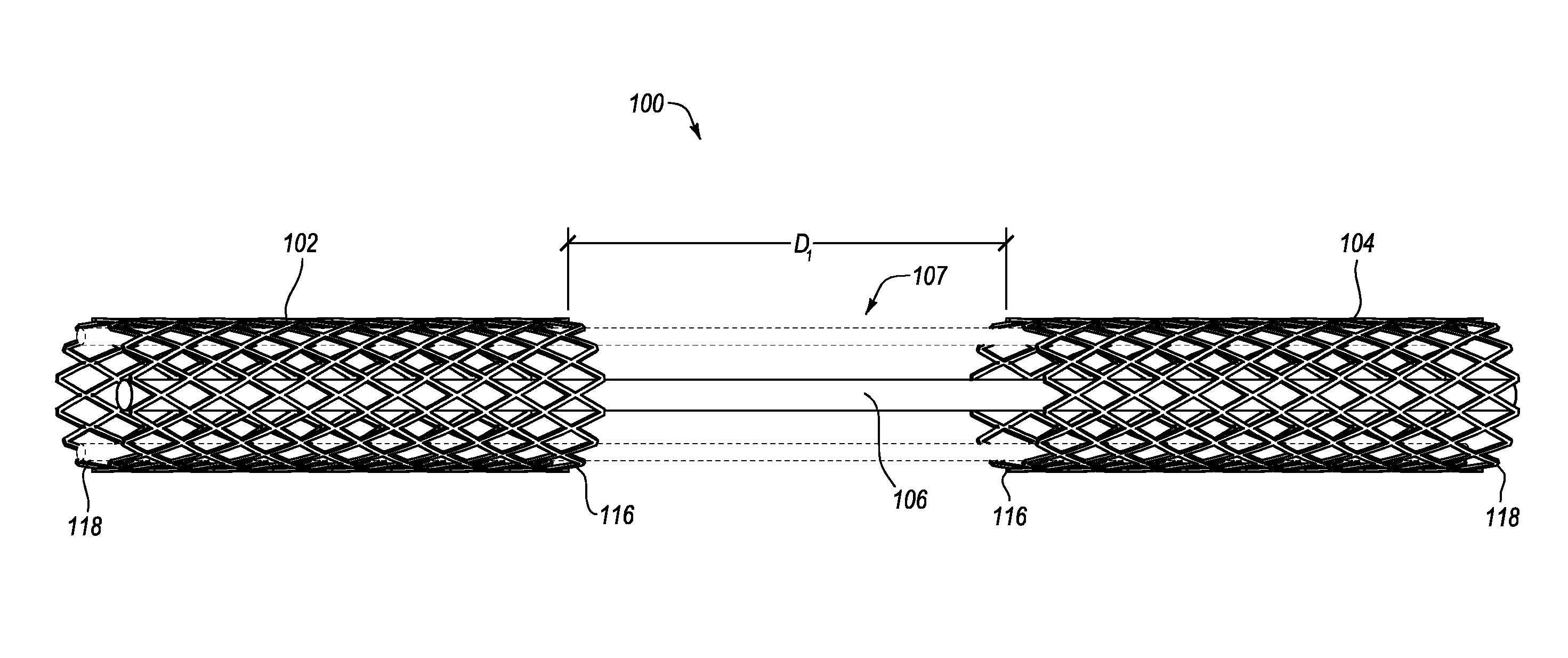 Intravascular cardiac restraining implants and methods for treating heart failure