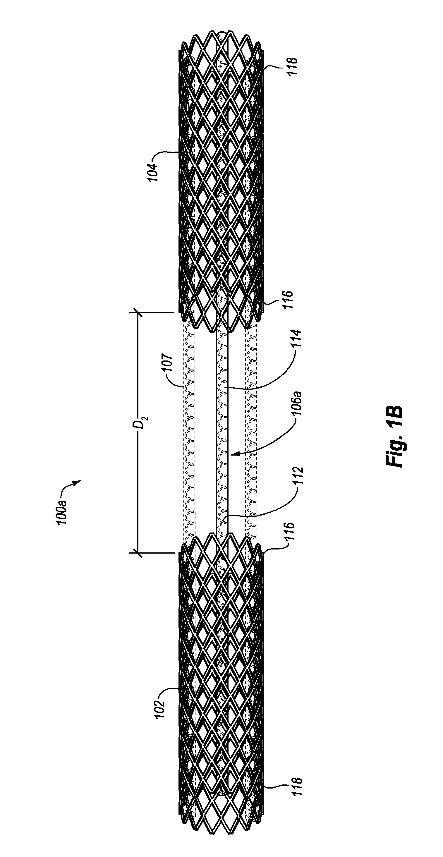 Intravascular cardiac restraining implants and methods for treating heart failure