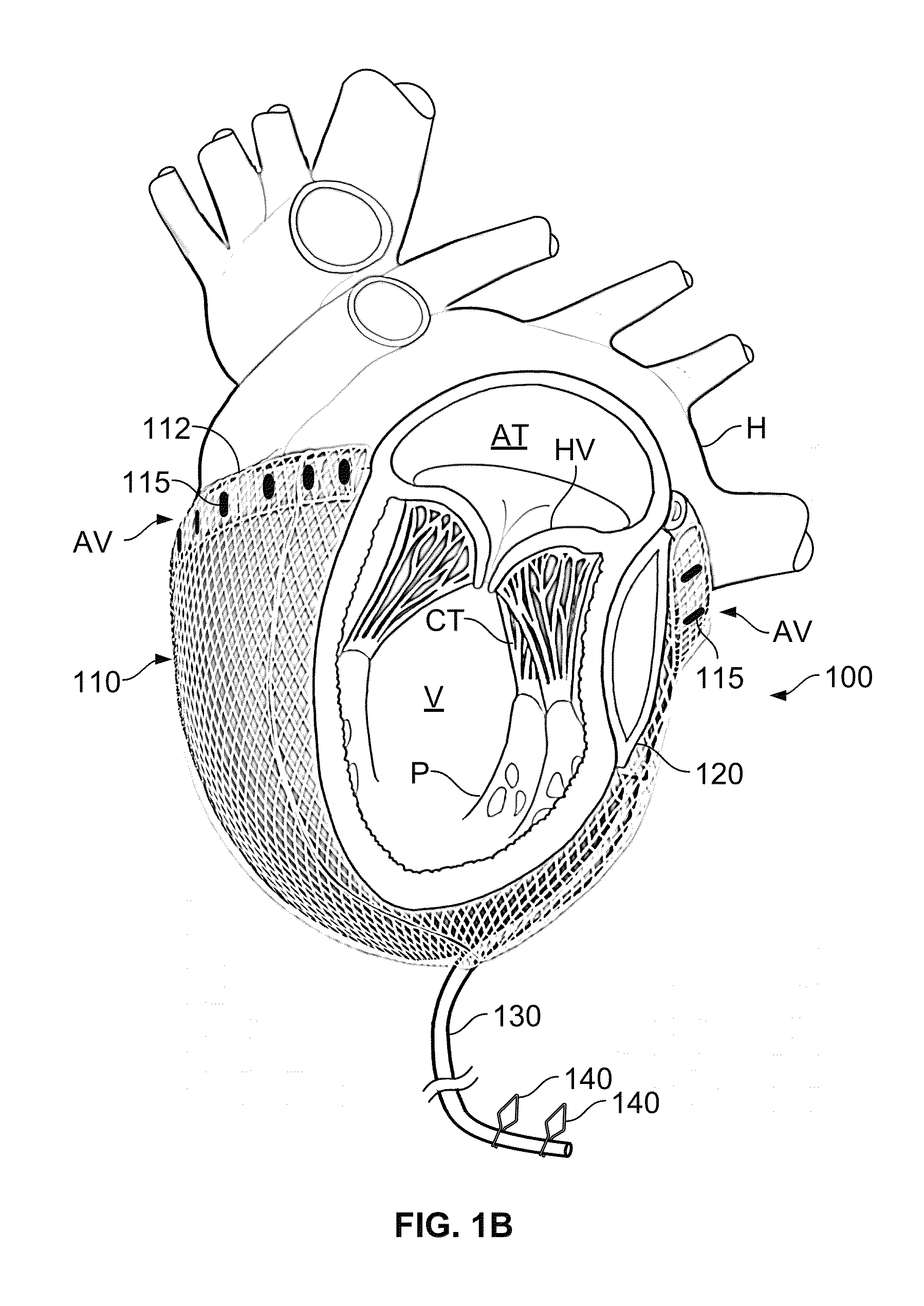 Cardiac treatment system and method