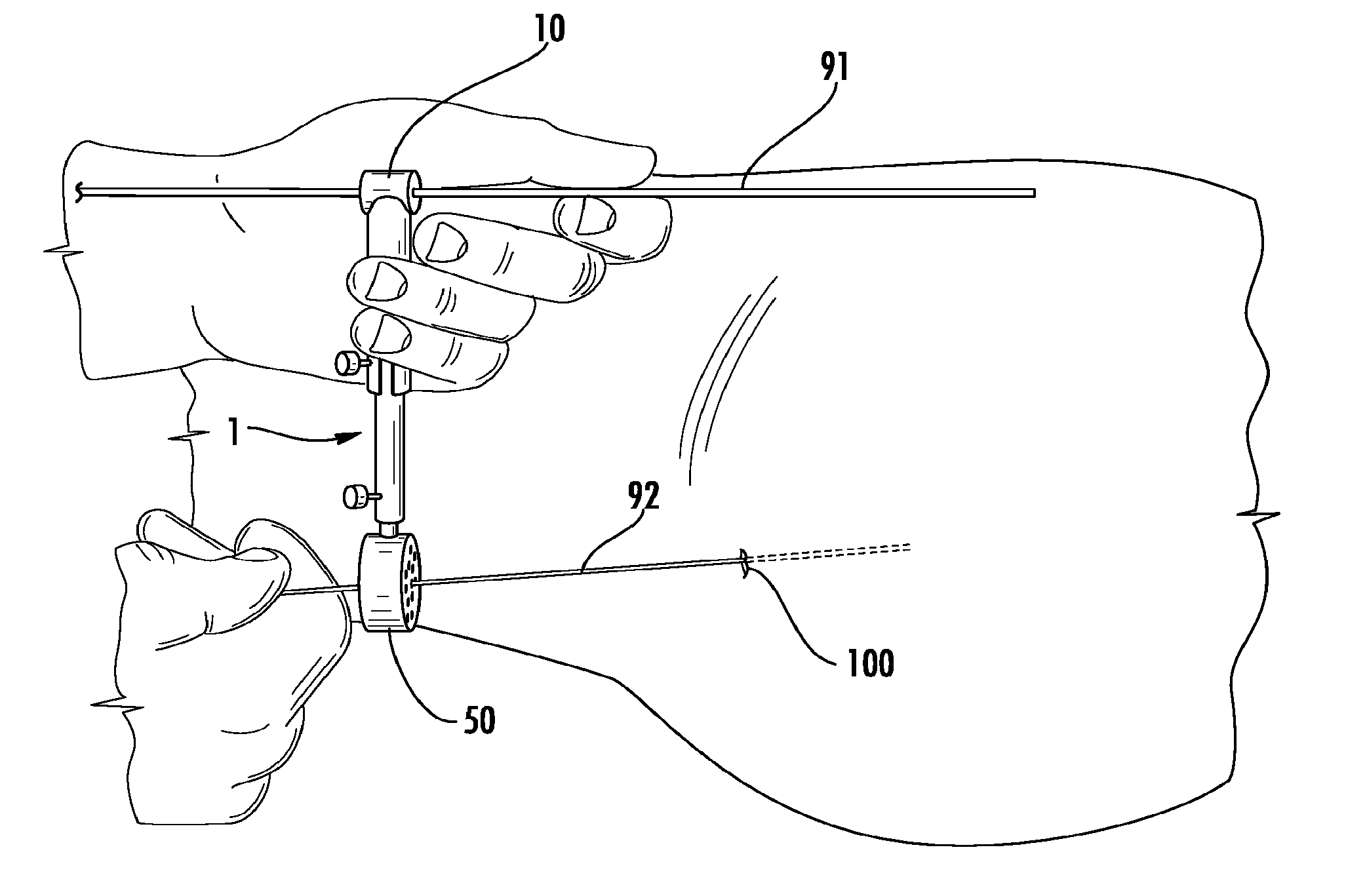 Guide pin placement for hip resurfacing