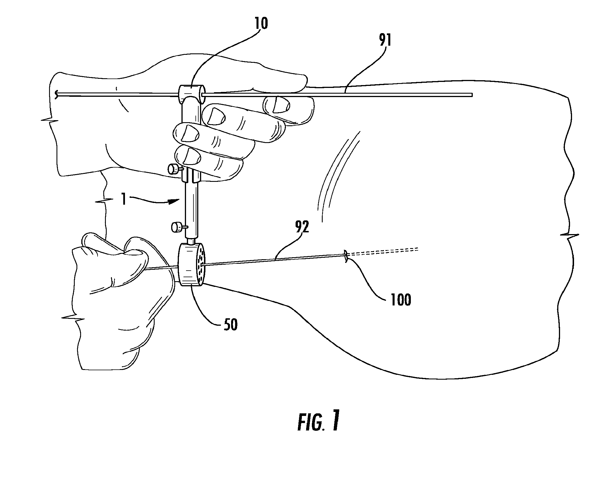 Guide pin placement for hip resurfacing