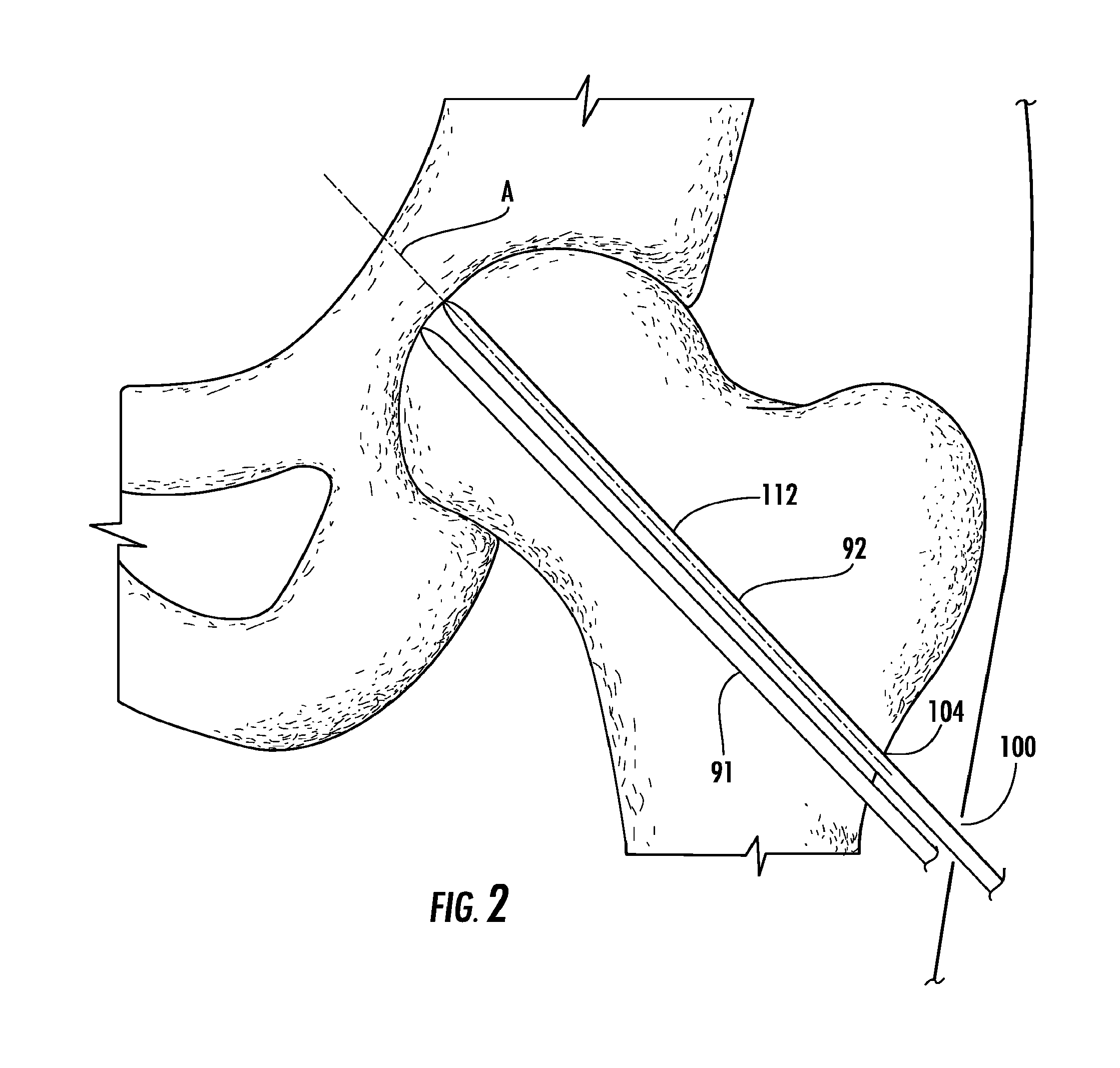 Guide pin placement for hip resurfacing