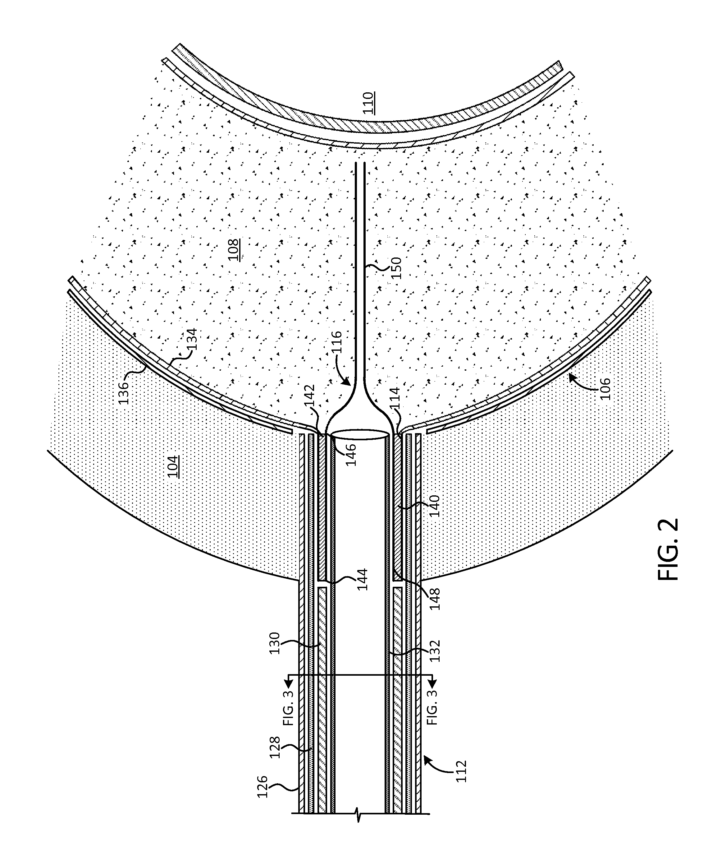 Percutaneous Implantable Nuclear Prosthesis