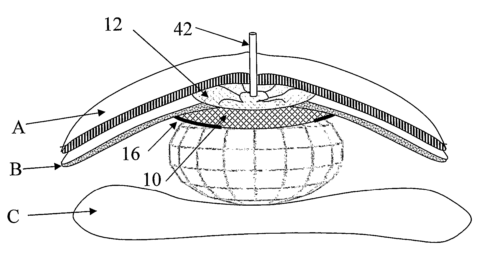 Hernia repair device