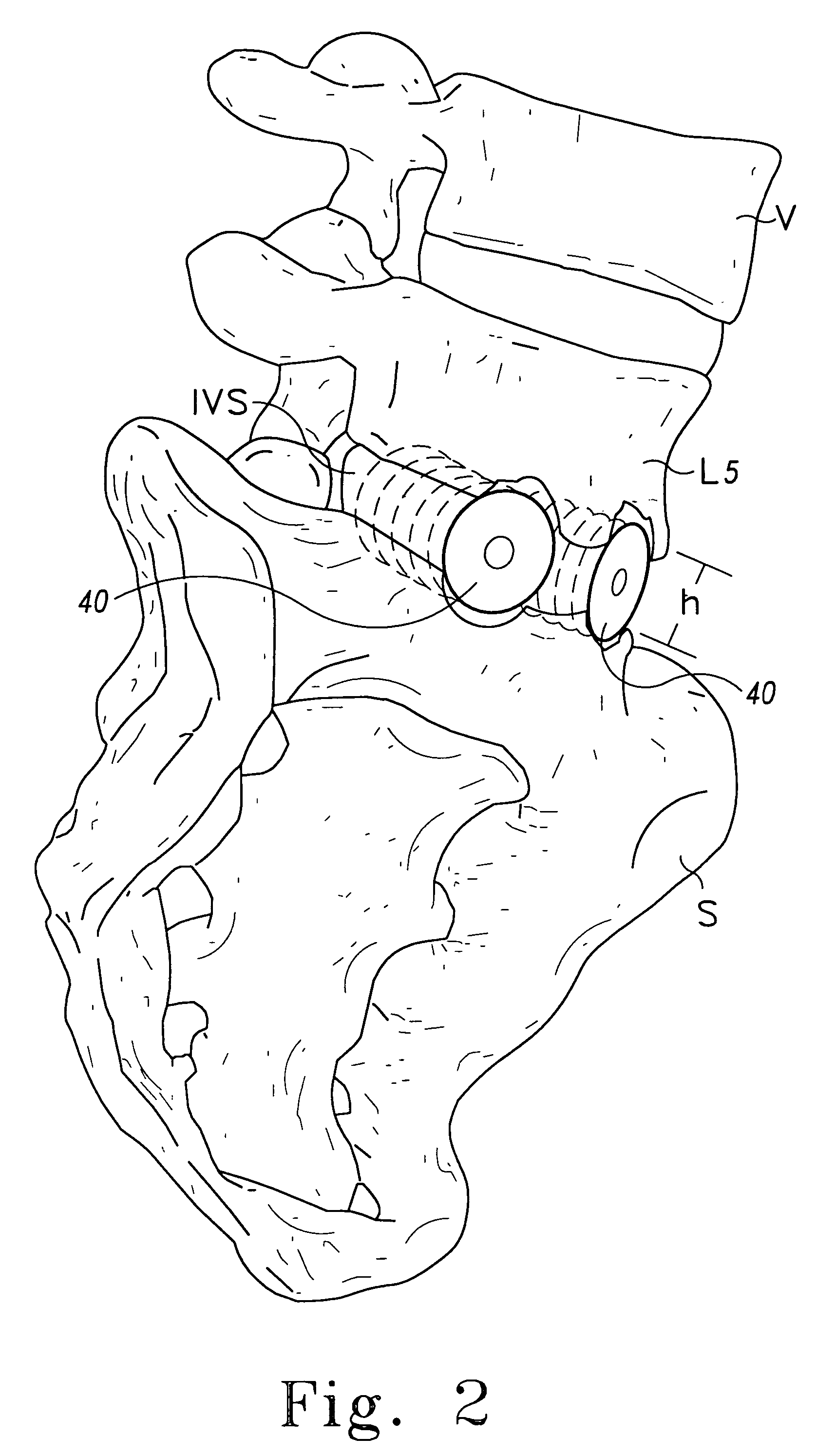 Bone grafts