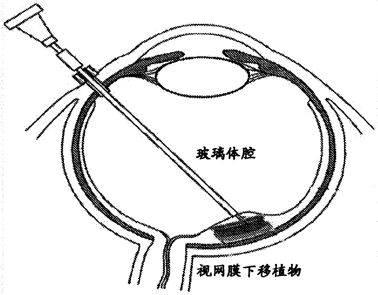 Compositions and methods for restoring or preventing loss of vision caused by disease or traumatic injury