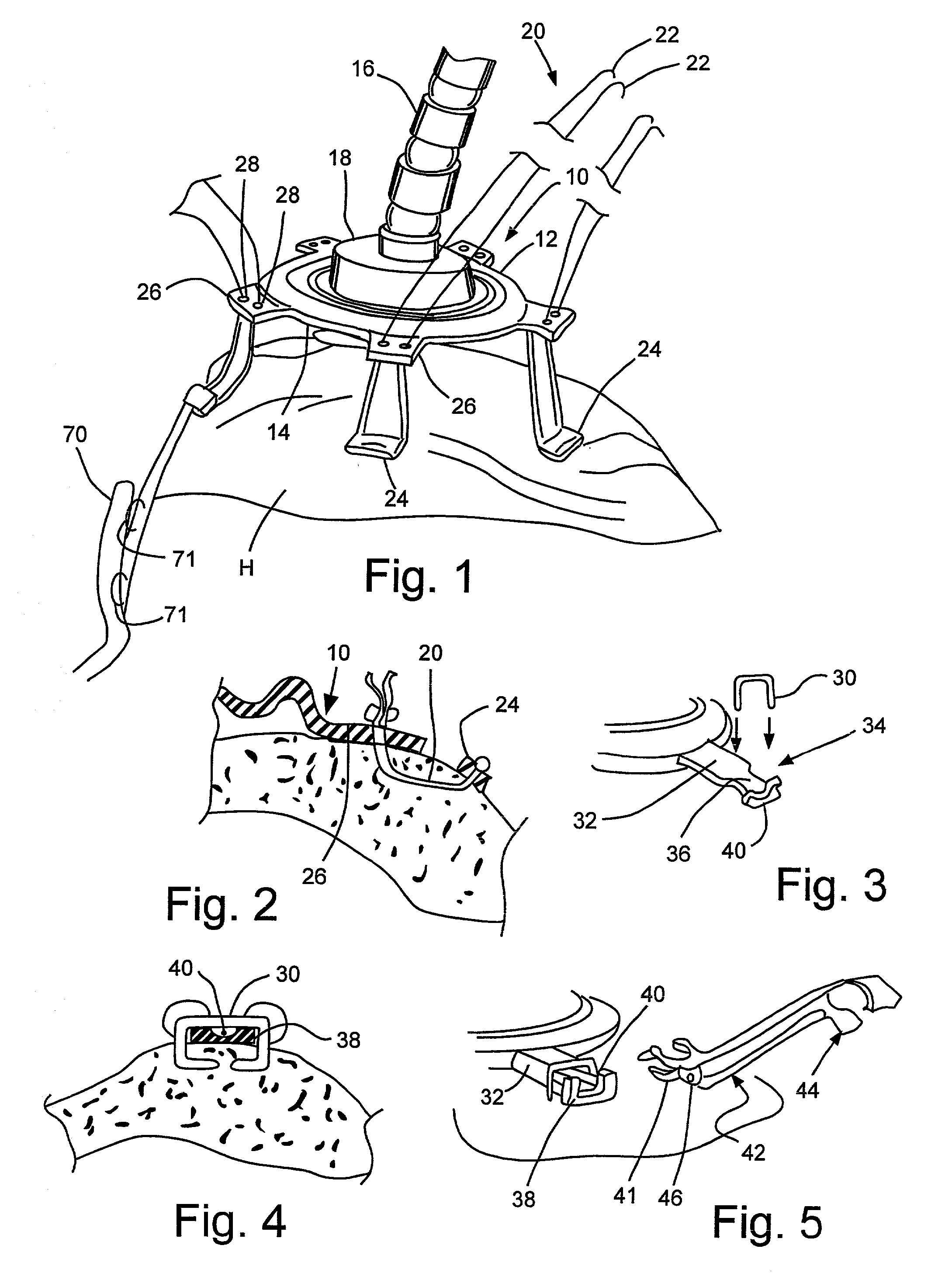 Device to permit offpump beating heart coronary bypass surgery