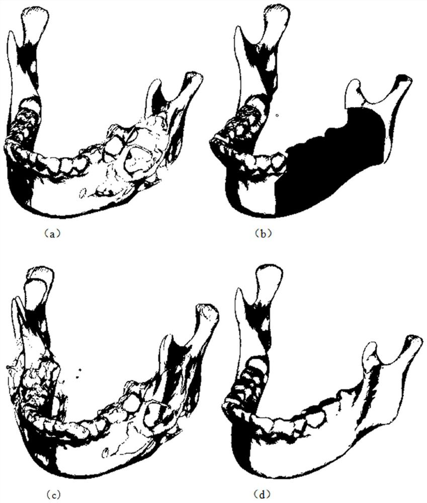 Mandibular implant and method of making same