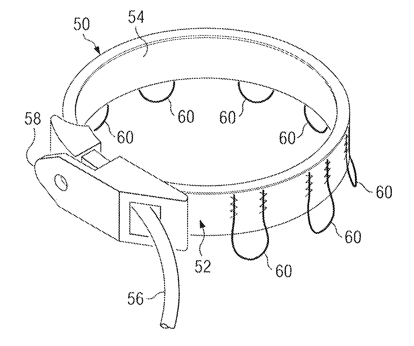 Method of and apparatus for prevention of adjustable gastric band slips