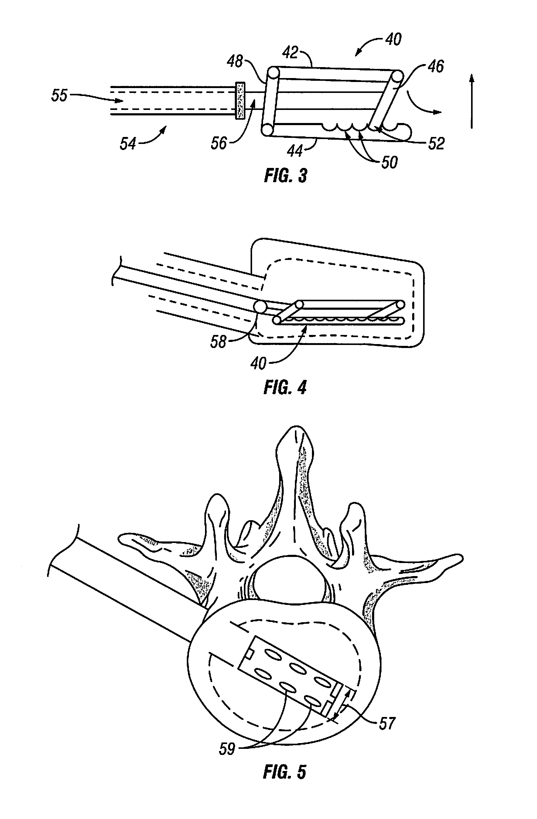 Devices and Methods for Treating Bone