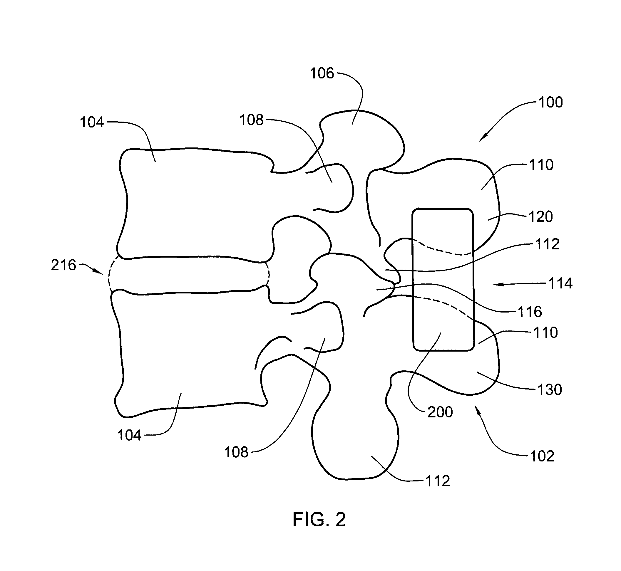 Spinal implant system