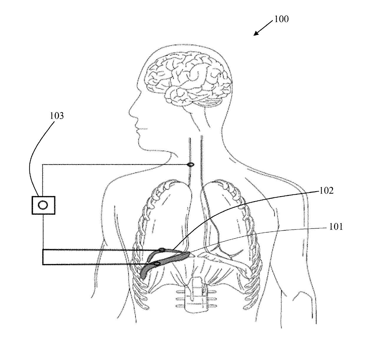 Artificial diaphragm having intelligent nanomagnetic particles for treatment of diaphragmatic paralysis